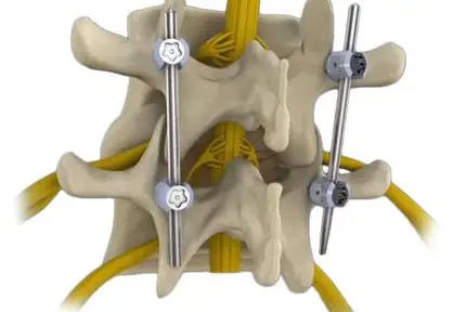Spinal Decompression and Fixation Surgery in India