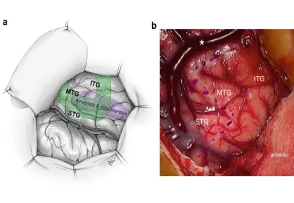 Craniotomy for Epilepsy / Temporal Lobectomy in India