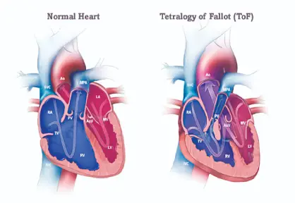 Tetralogy of Fallot (TOF) Repair in India