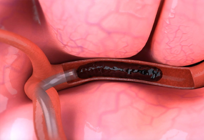 Thrombectomy in India