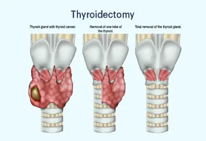 Thyroidectomy (Total/Partial) in India