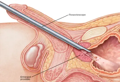 TURP (Transurethral Resection of the Prostate) in India