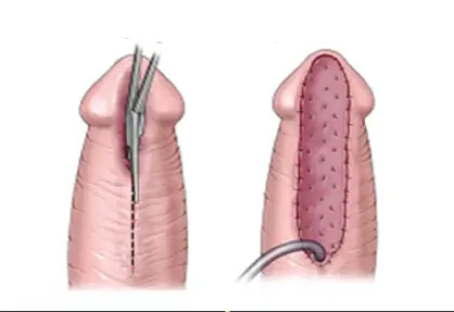 Urethroplasty in India