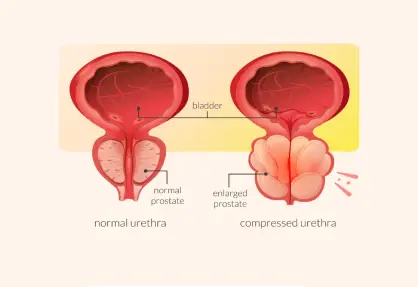 UroLift Procedure (Prostatic Urethral Lift) in India