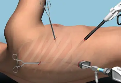 VATS Lung Surgery (Video-Assisted Thoracoscopic Surgery) in India