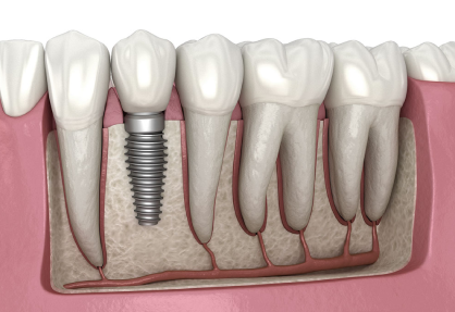 Dental Implants in India