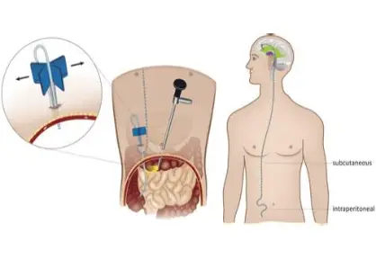 VP Shunt Surgery (Ventriculoperitoneal Shunt) in India