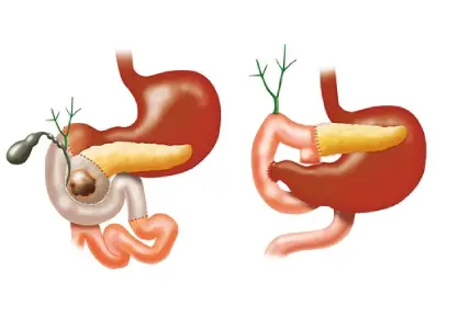 Whipple Surgery (Pancreaticoduodenectomy) in India